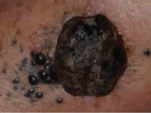 lunares cancer las tunas 3