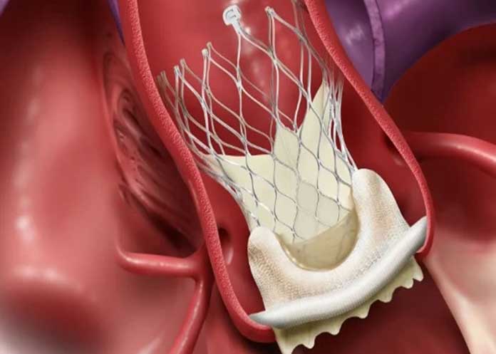 Nuevo proceder quirúrgico: implantación de una válvula aórtica percutánea en el corazón (TAVI)
