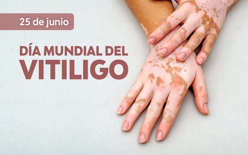 World Vitiligo Day is marked on June 25.