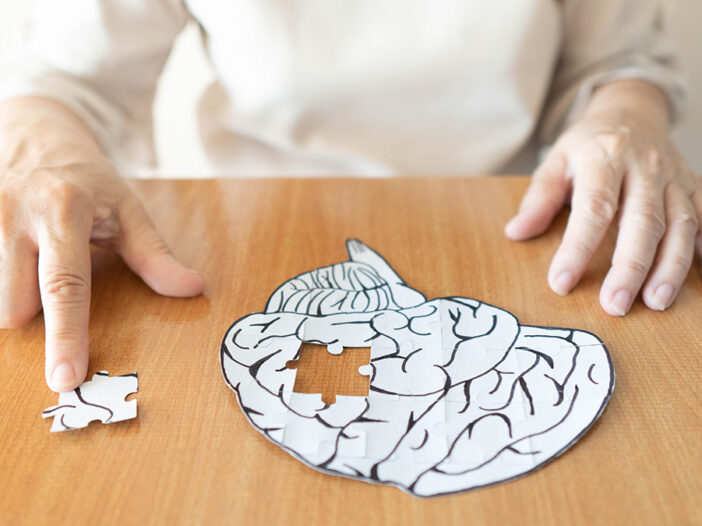 alzheimer foto Tomada de Infomed