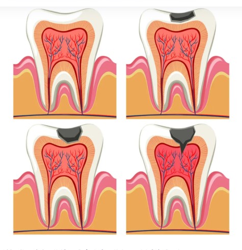caries