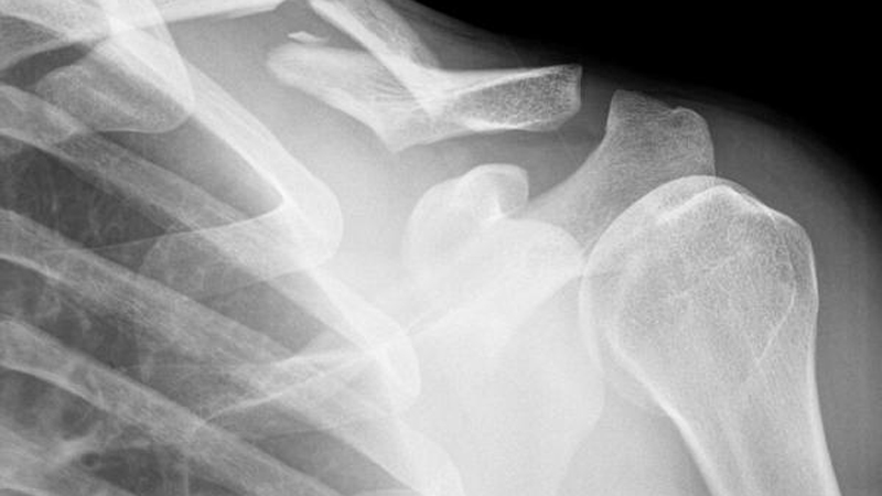radiologia Clavícula