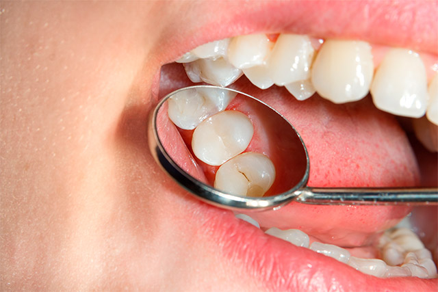 tipos de caries dentales